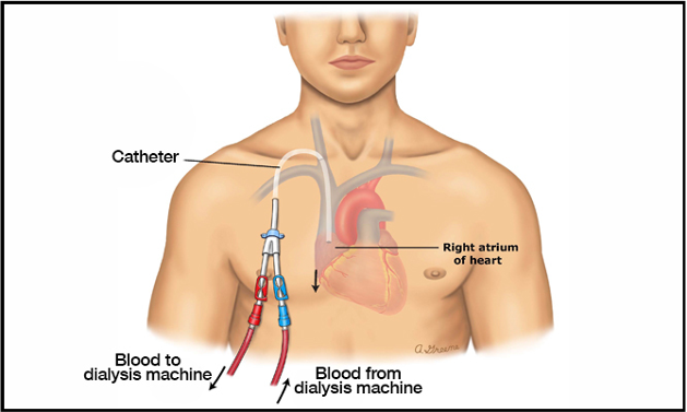 Catheter go into the heart