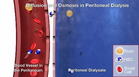 peritoneal dialysis osmosis and diffusion